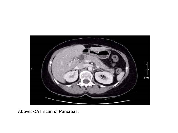 Above: CAT scan of Pancreas. 