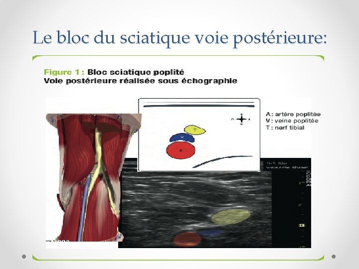 Le bloc du sciatique voie postérieure: 