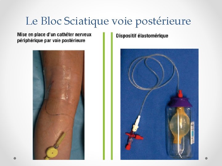 Le Bloc Sciatique voie postérieure 