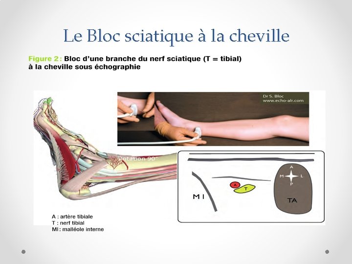 Le Bloc sciatique à la cheville 