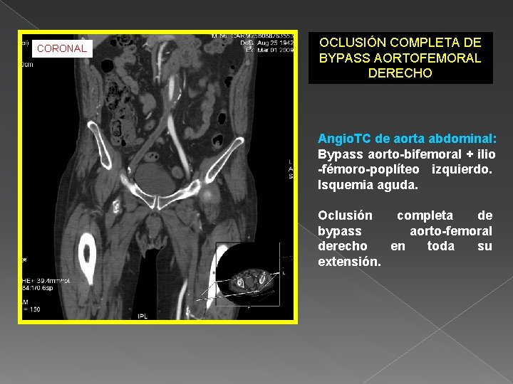 CORONAL OCLUSIÓN COMPLETA DE BYPASS AORTOFEMORAL DERECHO Angio. TC de aorta abdominal: Bypass aorto-bifemoral