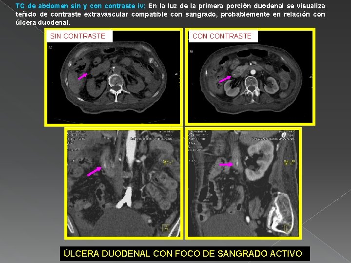 TC de abdomen sin y contraste iv: En la luz de la primera porción