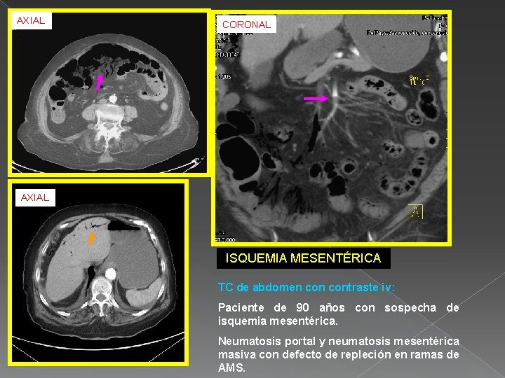 AXIAL CORONAL AXIAL ISQUEMIA MESENTÉRICA TC de abdomen contraste iv: Paciente de 90 años