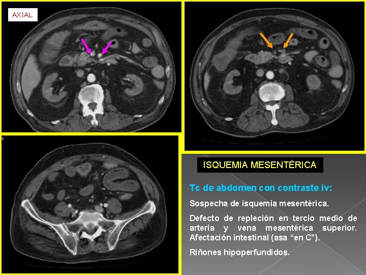 AXIAL ISQUEMIA MESENTÉRICA Tc de abdomen contraste iv: Sospecha de isquemia mesentérica. Defecto de