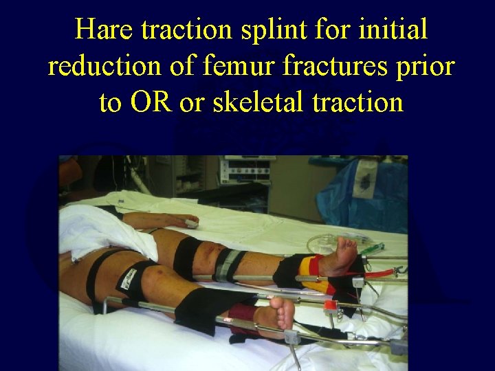 Hare traction splint for initial reduction of femur fractures prior to OR or skeletal