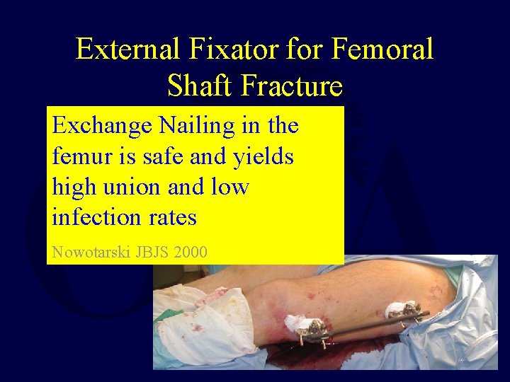 External Fixator for Femoral Shaft Fracture Multiply injured patient Exchange Nailing in the femur