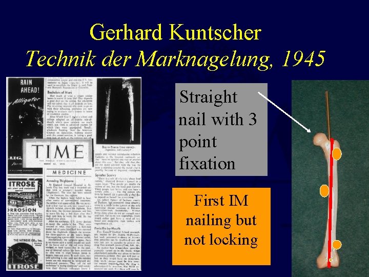 Gerhard Kuntscher Technik der Marknagelung, 1945 Straight nail with 3 point fixation First IM