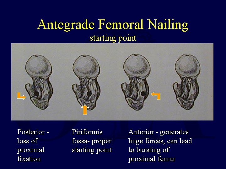 Antegrade Femoral Nailing starting point Posterior loss of proximal fixation Piriformis fossa- proper starting
