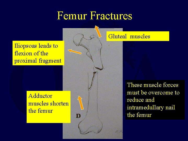 Femur Fractures Gluteal muscles Iliopsoas leads to flexion of the proximal fragment Adductor muscles