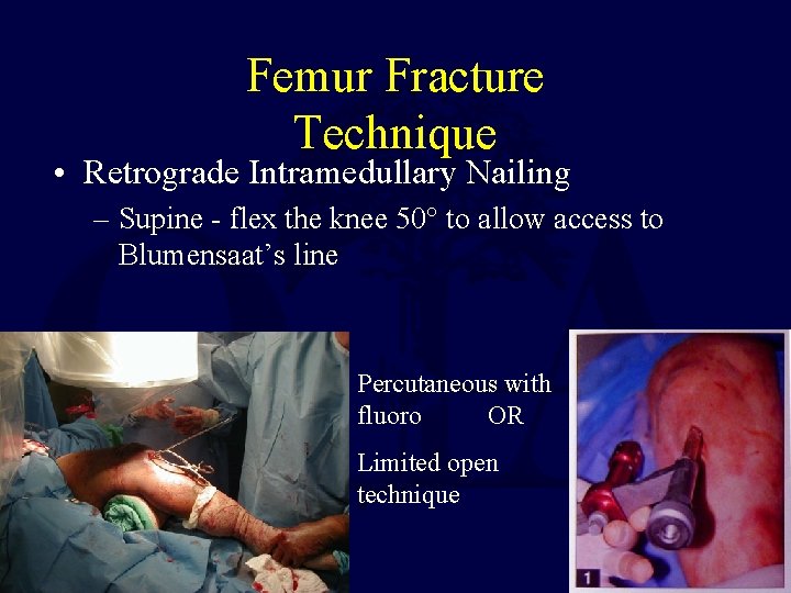 Femur Fracture Technique • Retrograde Intramedullary Nailing – Supine - flex the knee 50°