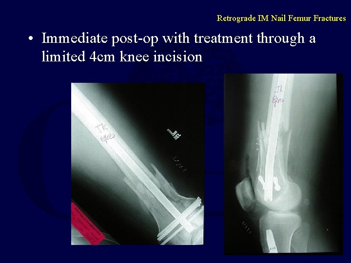 Retrograde IM Nail Femur Fractures • Immediate post-op with treatment through a limited 4