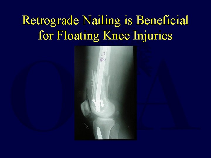 Retrograde Nailing is Beneficial for Floating Knee Injuries 