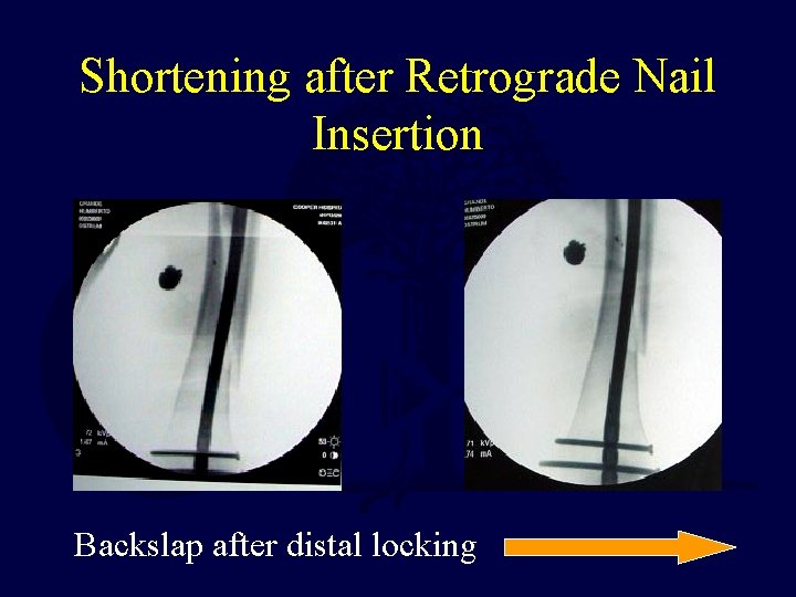 Shortening after Retrograde Nail Insertion Backslap after distal locking 
