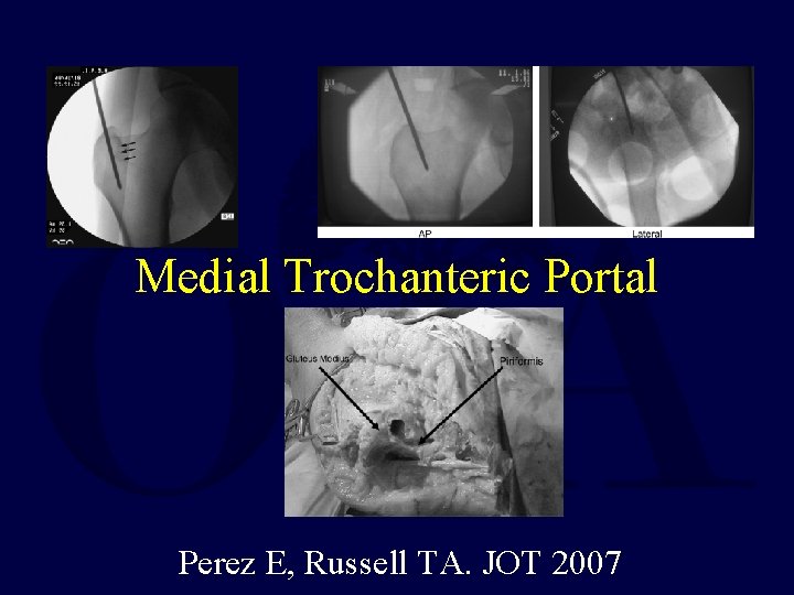 Medial Trochanteric Portal Perez E, Russell TA. JOT 2007 