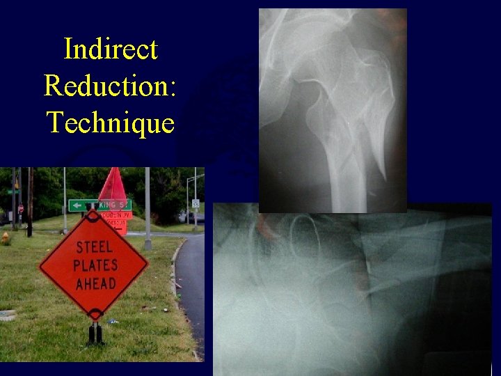 Indirect Reduction: Technique 