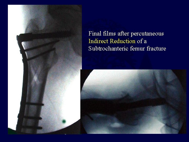Final films after percutaneous Indirect Reduction of a Subtrochanteric femur fracture 
