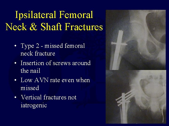 Ipsilateral Femoral Neck & Shaft Fractures • Type 2 - missed femoral neck fracture