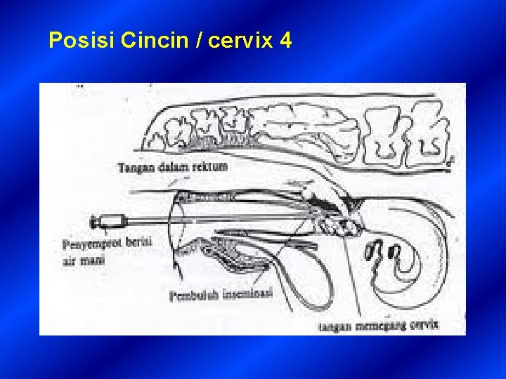 Posisi Cincin / cervix 4 
