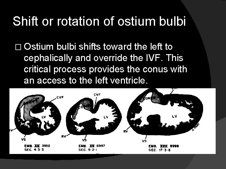 Shift or rotation of ostium bulbi � Ostium bulbi shifts toward the left to