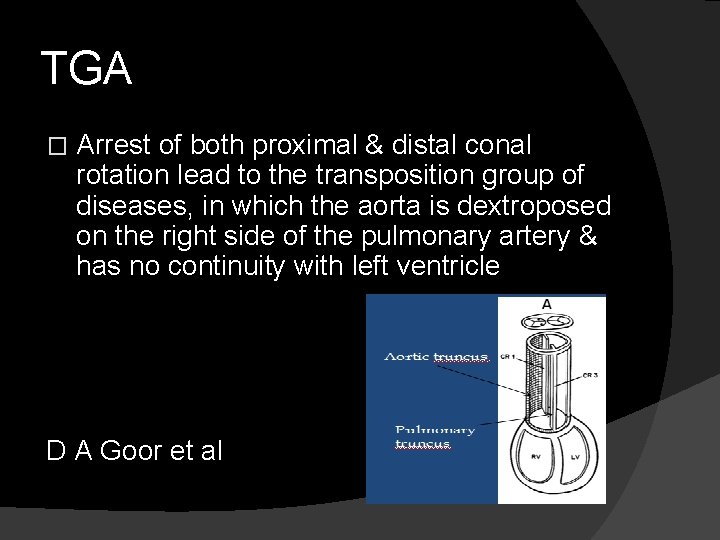 TGA � Arrest of both proximal & distal conal rotation lead to the transposition