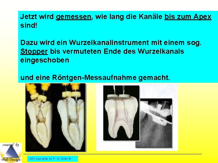 Jetzt wird gemessen, wie lang die Kanäle bis zum Apex sind! Dazu wird ein