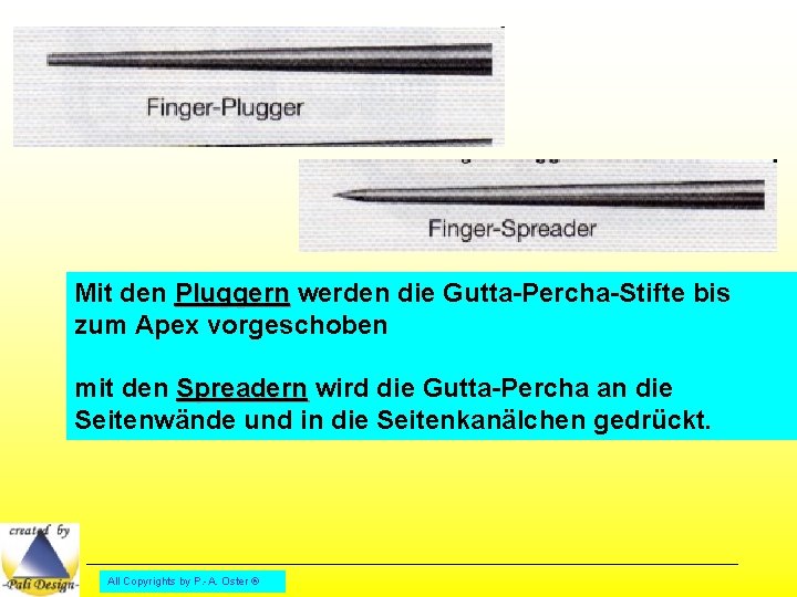 Mit den Pluggern werden die Gutta-Percha-Stifte bis zum Apex vorgeschoben mit den Spreadern wird