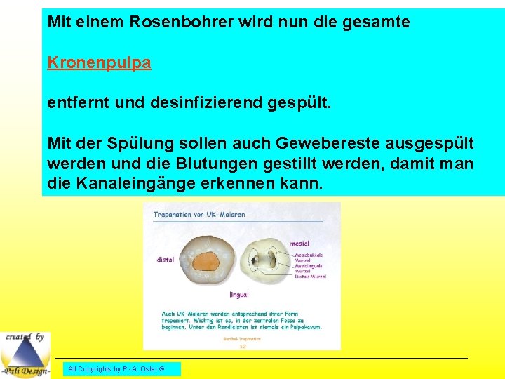 Mit einem Rosenbohrer wird nun die gesamte Kronenpulpa entfernt und desinfizierend gespült. Mit der