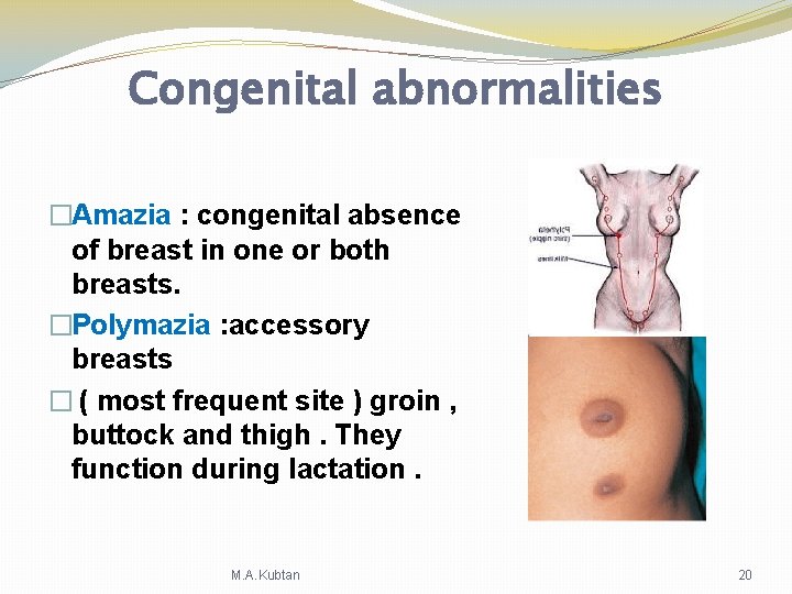 Congenital abnormalities �Amazia : congenital absence of breast in one or both breasts. �Polymazia