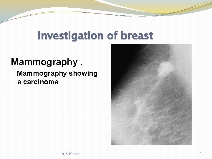 Investigation of breast Mammography showing a carcinoma M. A. Kubtan 9 