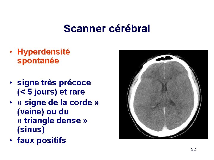Scanner cérébral • Hyperdensité spontanée • signe très précoce (< 5 jours) et rare
