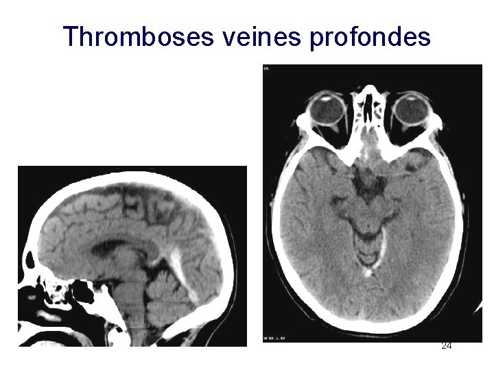 Thromboses veines profondes 24 