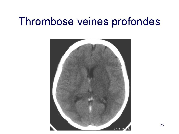 Thrombose veines profondes 25 