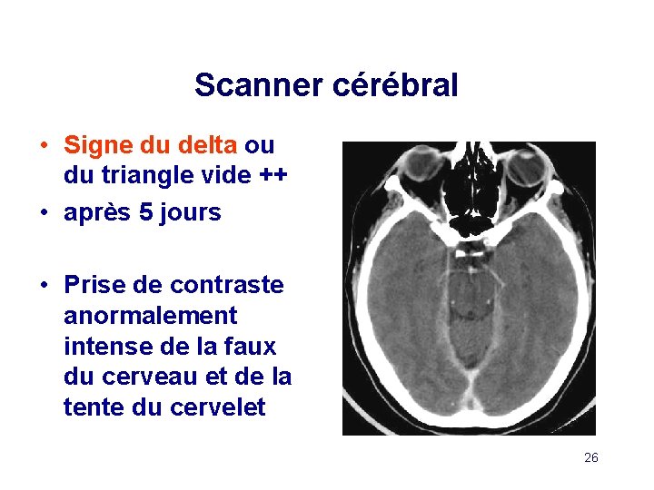 Scanner cérébral • Signe du delta ou du triangle vide ++ • après 5