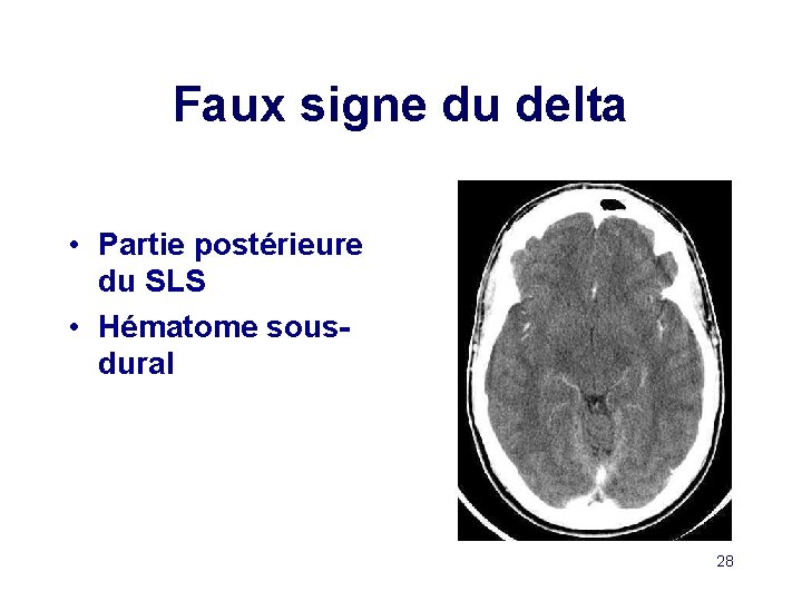 Faux signe du delta • Partie postérieure du SLS • Hématome sousdural 28 