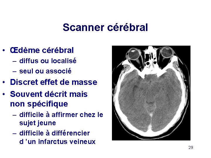 Scanner cérébral • Œdème cérébral – diffus ou localisé – seul ou associé •