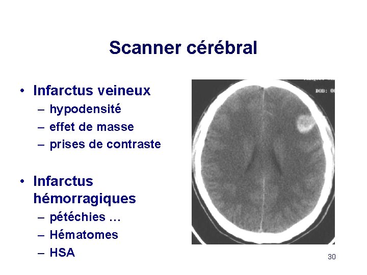 Scanner cérébral • Infarctus veineux – hypodensité – effet de masse – prises de