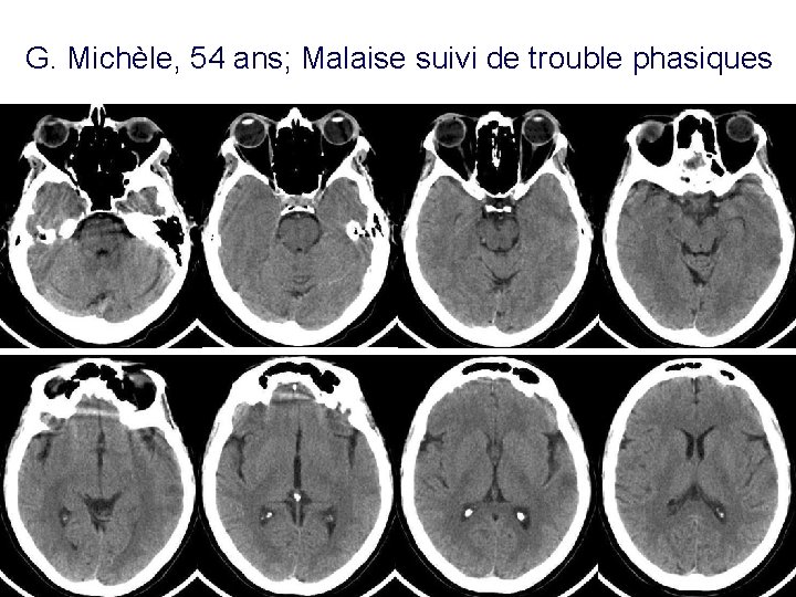 G. Michèle, 54 ans; Malaise suivi de trouble phasiques 33 