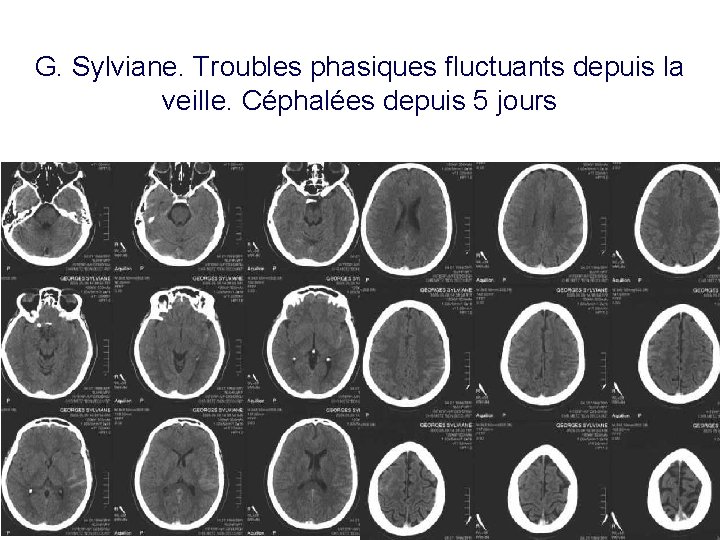 G. Sylviane. Troubles phasiques fluctuants depuis la veille. Céphalées depuis 5 jours 35 