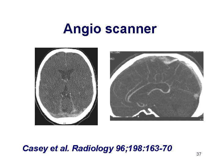 Angio scanner Casey et al. Radiology 96; 198: 163 -70 37 