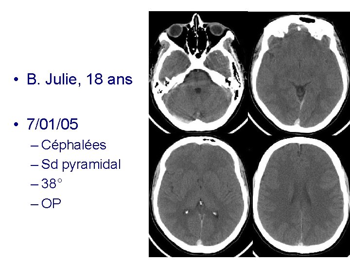  • B. Julie, 18 ans • 7/01/05 – Céphalées – Sd pyramidal –