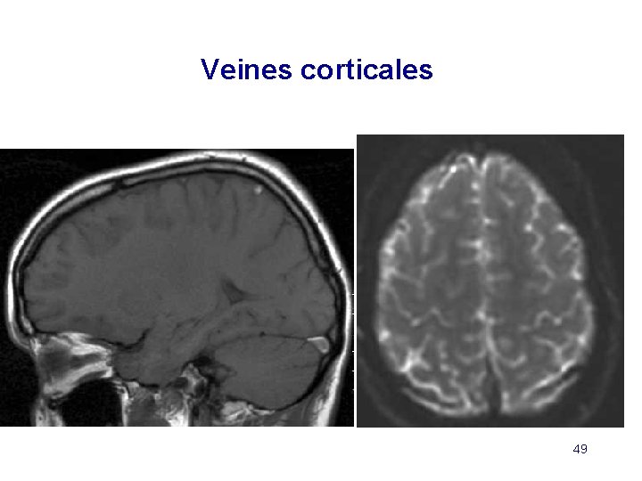 Veines corticales 49 