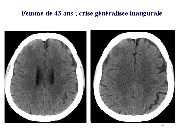 Femme de 43 ans ; crise généralisée inaugurale 51 