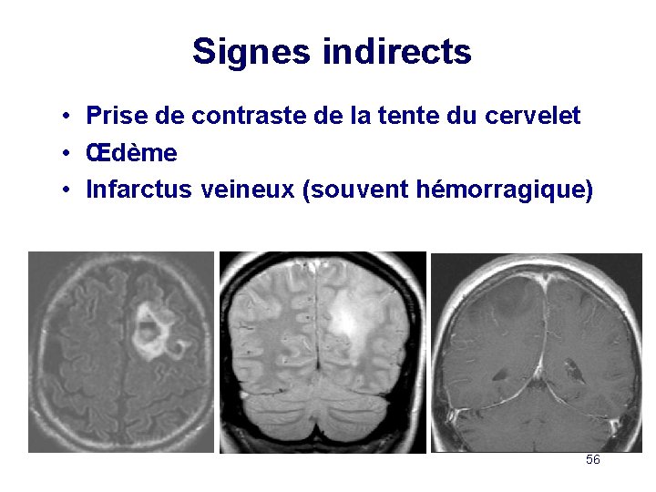 Signes indirects • Prise de contraste de la tente du cervelet • Œdème •