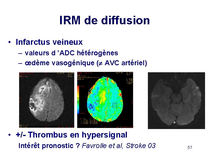 IRM de diffusion • Infarctus veineux – valeurs d ’ADC hétérogènes – œdème vasogénique