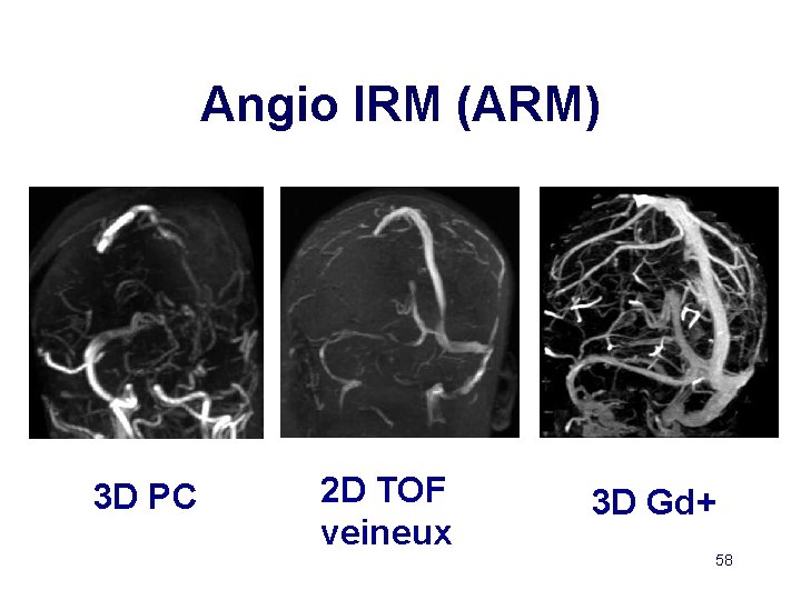 Angio IRM (ARM) 3 D PC 2 D TOF veineux 3 D Gd+ 58