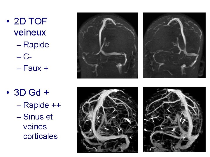  • 2 D TOF veineux – Rapide – C– Faux + • 3