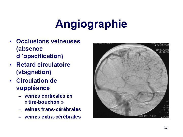 Angiographie • Occlusions veineuses (absence d ’opacification) • Retard circulatoire (stagnation) • Circulation de