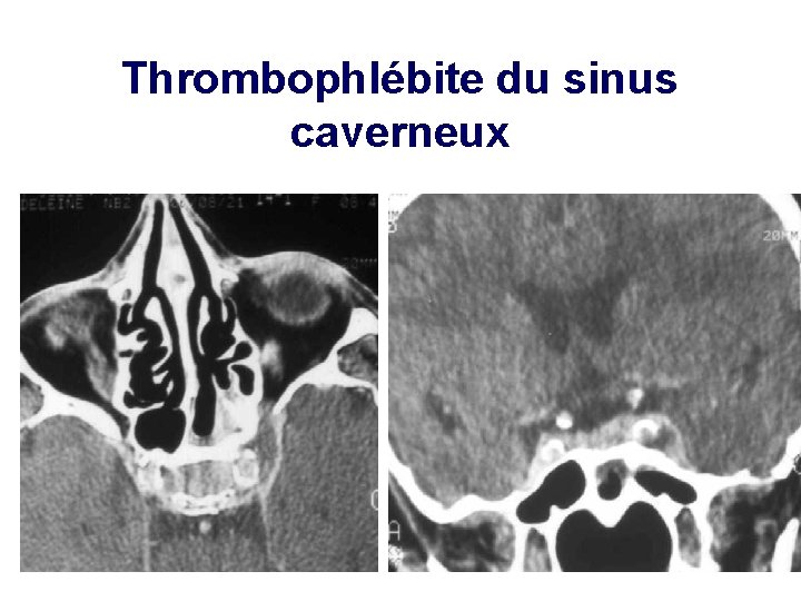 Thrombophlébite du sinus caverneux 8 