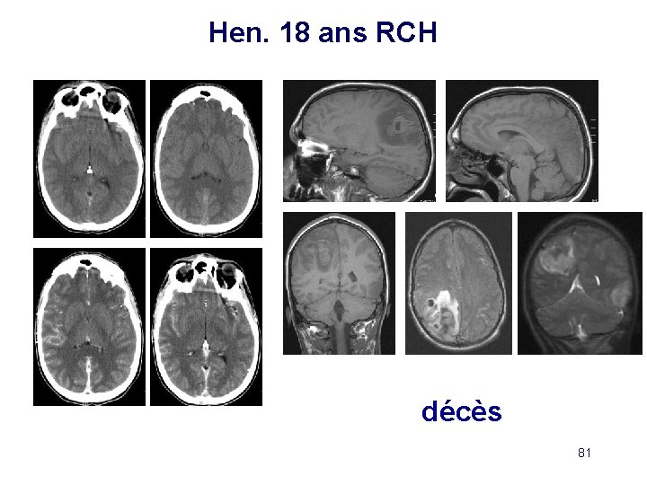 Hen. 18 ans RCH décès 81 