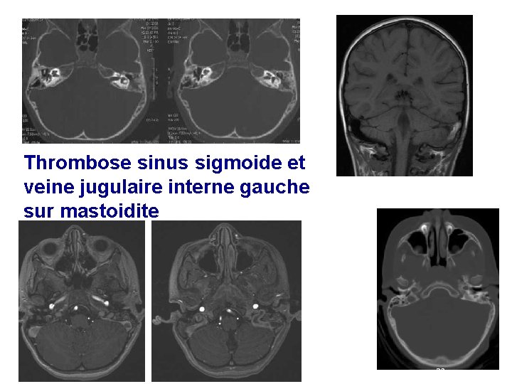 Thrombose sinus sigmoide et veine jugulaire interne gauche sur mastoidite 9 